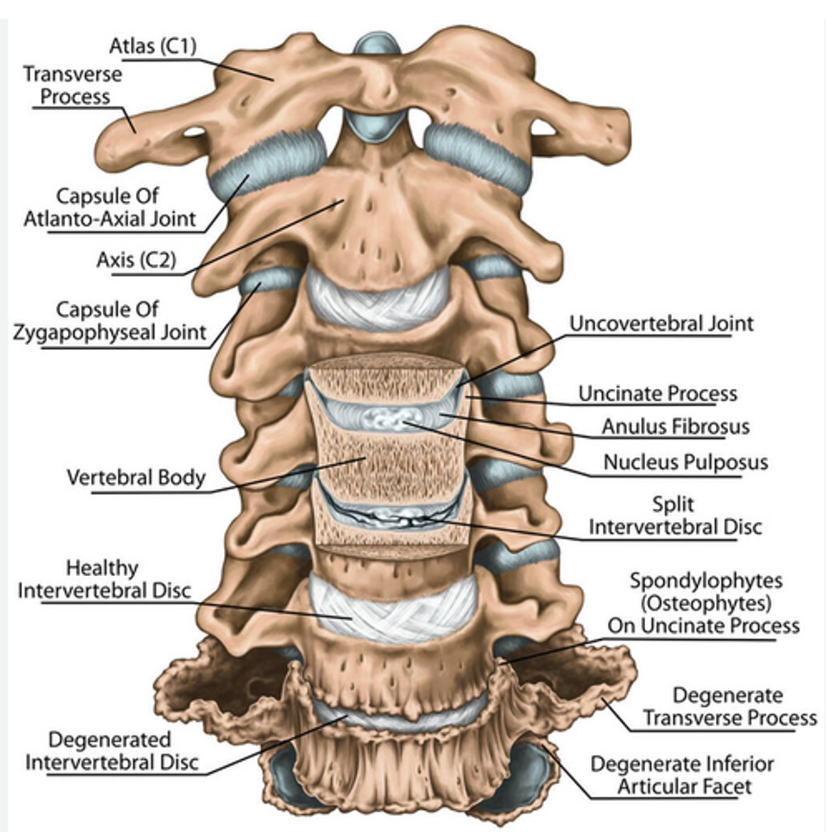 <p>loss of disc height increases WB and results in formation of UV osteophytes and hard posterior disc protrusions</p><p>- may encroach on intervertebral and spinal canals (stenosis)</p>