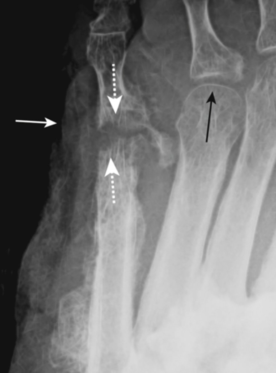 <p>synovial membrane infection from a wound infection or from direct contiguous extension from osteomyelitis adjacent to joint</p><p>- rapid destruction of articular cartilage</p><p>- usually monoarticular</p><p>- associated soft tissue swelling</p><p>- osteopenia from hyperemia of inflammation</p>