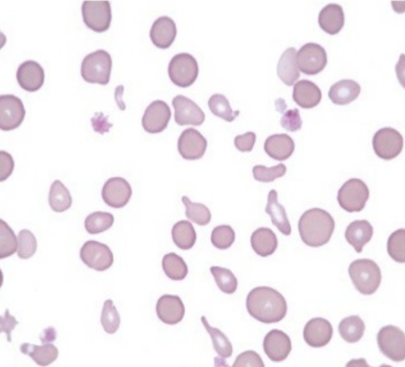 <p>What type of cell abnormality is this? </p>