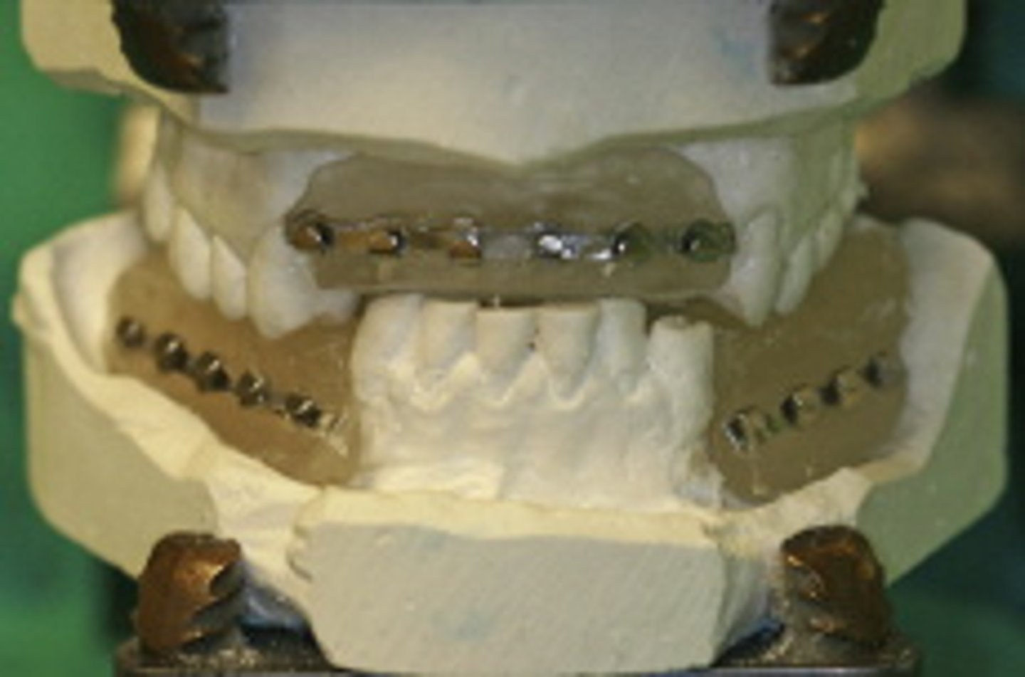 <p>ID the closed treatment/ maxillomandibular fixation:</p><p>- used for patients will large edentulous spaces</p>