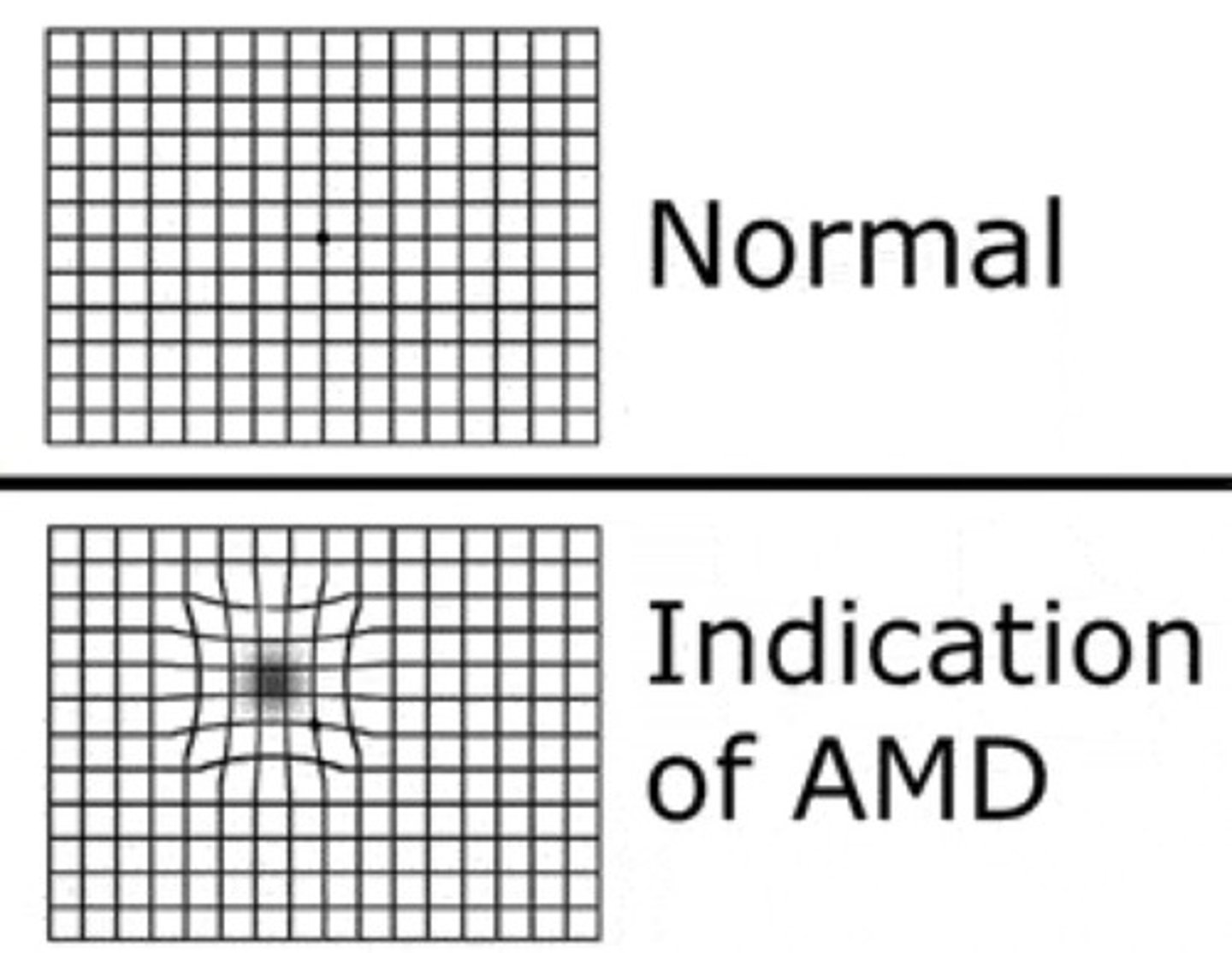 <p>Ask the patient to self-test using the Amsler grid.</p>