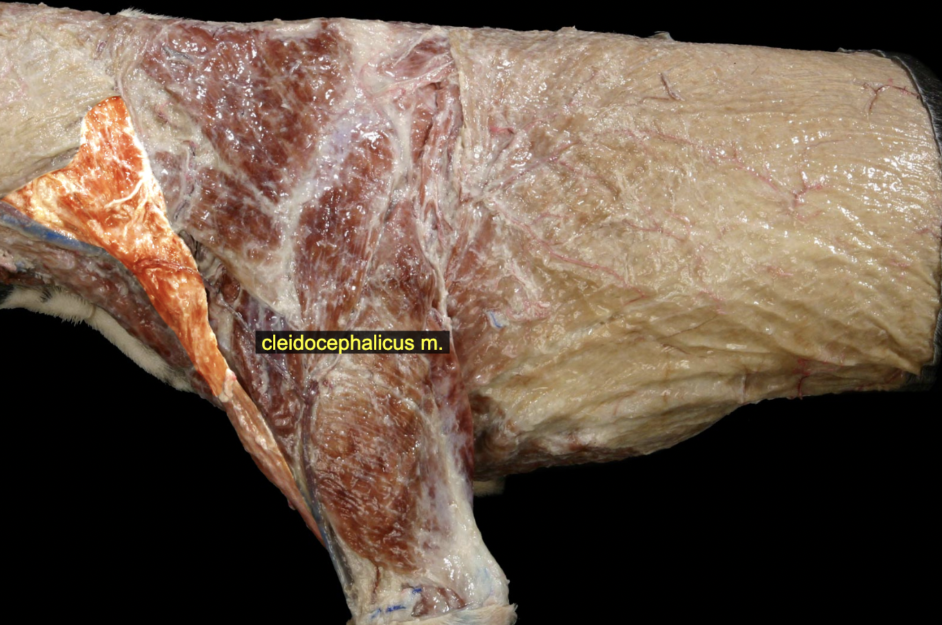 <p>O: Clavicular intersection<br>I: Dorsal median raphe of the neck &amp; the mastoid process of skull <br>N: Ventral brr. of cervical spinal nn., accessory n.</p><p>A: Advance limb, extend shoulder, lateral flexion of neck (unilateral action) or fixation of neck (bilateral action)</p>