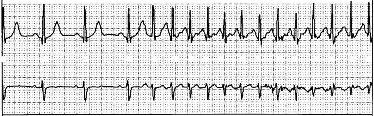 <p>HR:&gt;100 bpm</p><p>P-wave:1 per QRS complex</p><p>Regularity: Regular</p><p>PR Interval: Normal</p><p>QRS Duration: Normal</p><p></p>