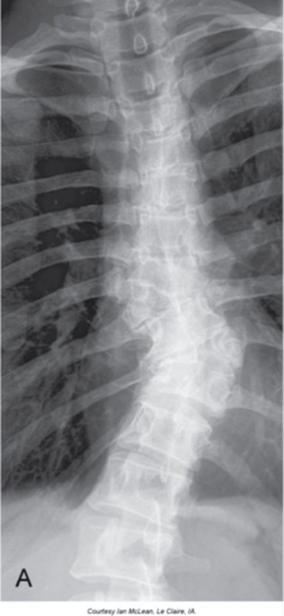 <p>Clinical significance of hemivertebra</p>