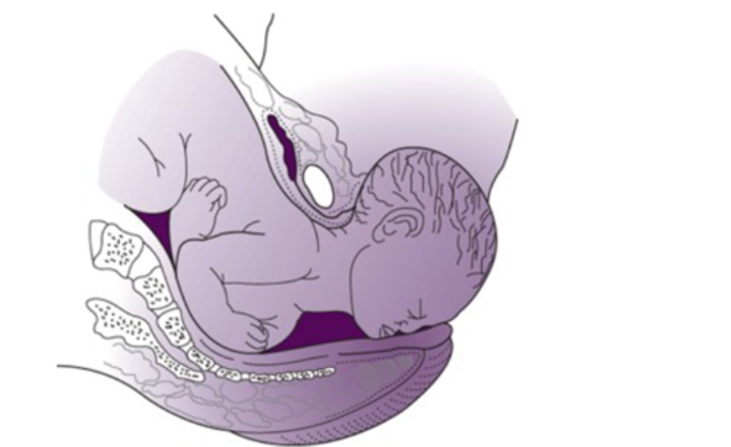 <p>-fetus has descended to the introitus and then deflexes</p><p>-ring of fire</p>