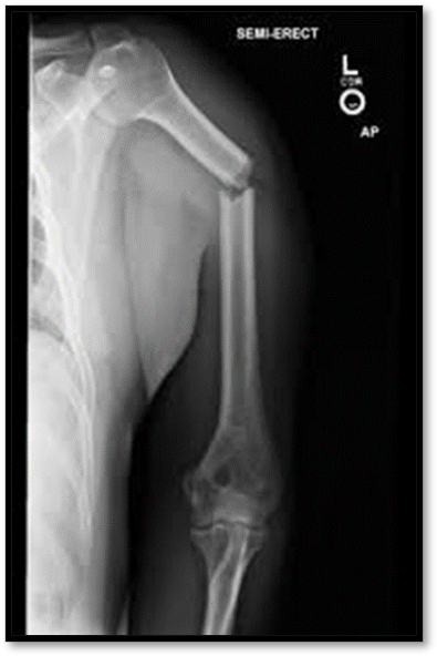 <p><strong><span>Humerus Fracture </span>( Def. / S&amp;S / Comp. / Diagnostic / Tx / Nursing)</strong></p>