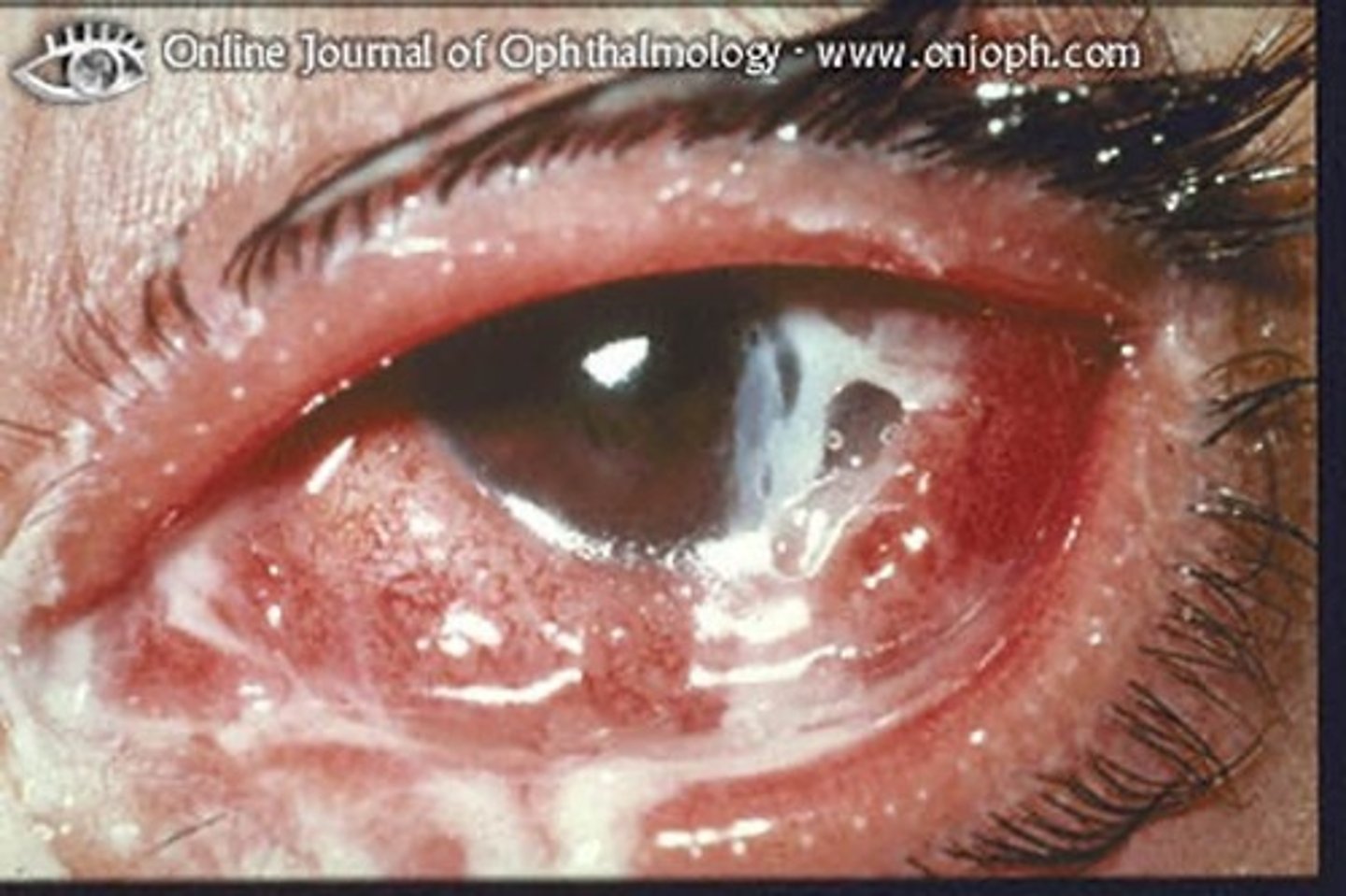 <p>more purulent - pus</p>