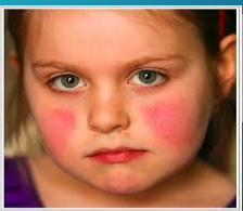 <p><strong>Erythema Infectiosum: Symptoms</strong></p><p>-Prodromal period (low grade ______, malaise, headache, and myalgias) </p><p>-Erythematous _____ _____ “slapped cheek” that appears __-__ days after prodromal period </p><p>-Erythematous __________, maculopapular, truncal rash described as lacy and _____________</p><ul><li><p>Presents __-__ days after malar rash</p></li><li><p>Lasts on average 11 days </p></li><li><p>Can wax and wane </p></li></ul><p></p>