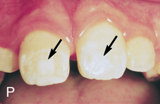<ul><li><p>A disturbance developed in the apposition stage that results in a reduction in the <strong>quality </strong>of the enamel maturation</p></li><li><p>teeth appear more opaque, yellower, or even browner within because of an intrinsic staining of enamel</p></li><li><p>could have “turner spots” that are single affected areas, or could affect the entire crown</p></li></ul><p></p>