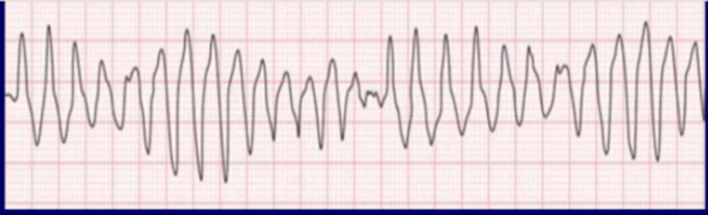 <p>Originate: ventricular automaticity focus</p><p>QRS complex: twist</p><p>P wave: none</p><p>Heart rate: very rapid</p><p>R-R intervals: irregular</p>