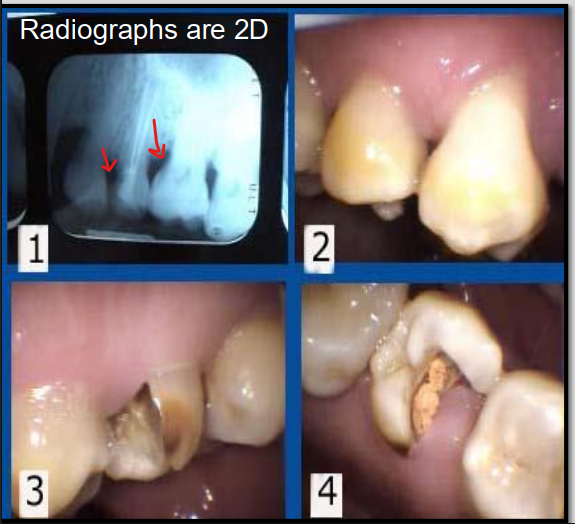 <p>Radiographs show a 2D image of a 3D object which can lead to underestimation of the lesions extent. </p><ul><li><p>Lesions can be deeper than they appear on the radiograph. </p></li></ul><p></p>