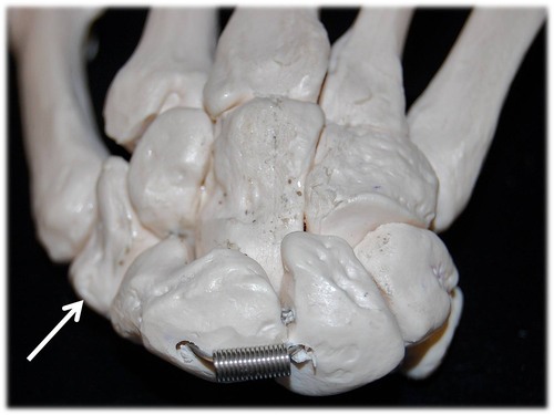 Name this specific bone of the hand (posterior view).