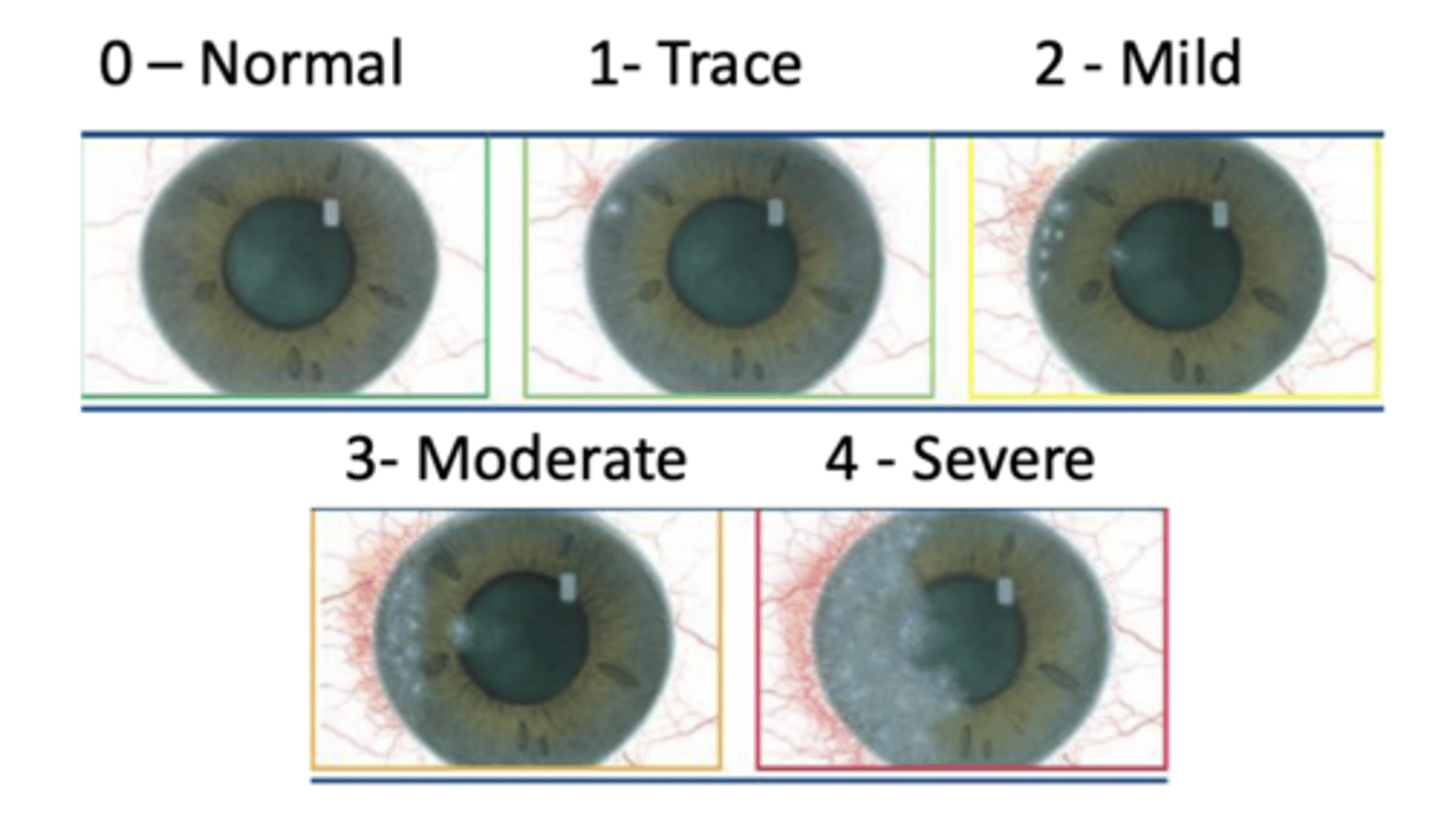 <p>Describe sterile vs infectious infiltrates</p>