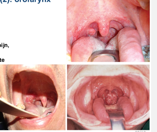 <p>Alcohol + nicotine<br>HPV-gerelateerde tumoren manifesteren zich thv orofarynx<br>Keelpijn, gerefereerde oorpijn (otalgie), dysfagie<br>Meestal bestraling als eerste keus<br>- Dysfagie! <br>- Vaak sondevoeding</p>