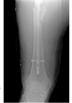 <p><strong>Femur Shaft Fracture: Treatment and Complications</strong></p><p>-Treatment</p><ul><li><p>Initial → __________ if unstable, pain control, immobilization</p></li><li><p>If open fracture, add antibiotics and ________ prophylaxis </p></li><li><p>Ortho consult</p></li></ul><p>-Complications </p><ul><li><p>___________, malunion, delayed union, __________, pain d/t ortho hardware</p></li><li><p>_____________, neurovascular injury, __________ syndrome, hardware failure, PE (DVT, ___ _______) </p></li></ul><p></p>
