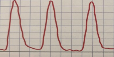 <ol><li><p>If this waveform was obtained from an analog doppler velocimetry, would this easily be ruled out as abnormal? </p></li><li><p>If no, why not?</p></li></ol><p></p>