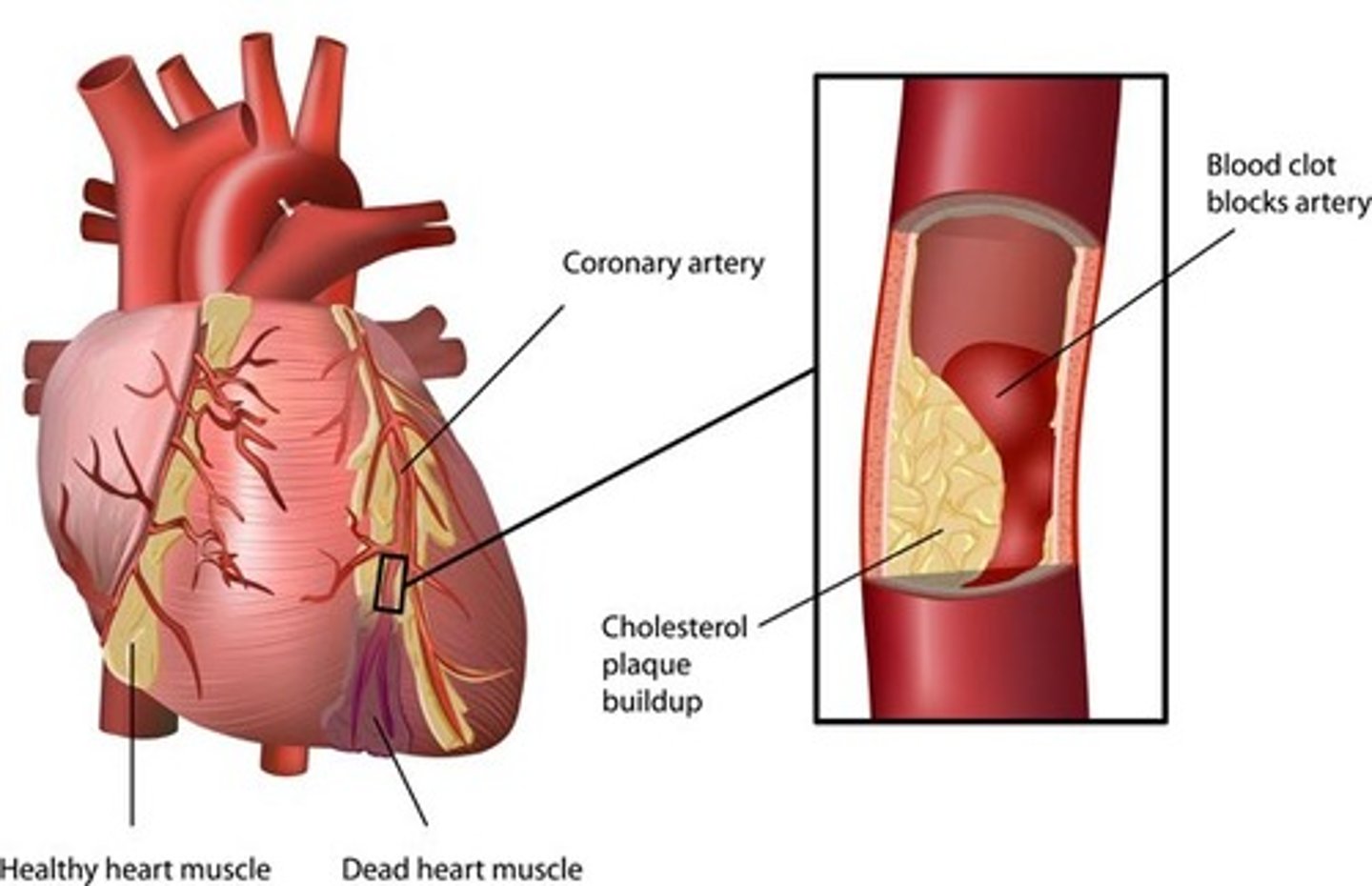 <p>hardening of the arteries, buildup of fatty plaque</p>