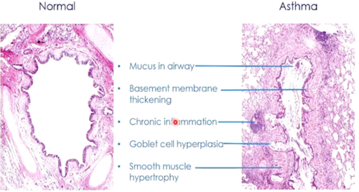 <p>thick mucus</p><p>epithelial basement</p><p>membrane makes goblet cells (makes more mucus) and have increased macrophages</p><p>increase size of smooth muscle layer</p><p>IgEs, mast cells, lymphocytes, neutrophils, and eosinophils are within the bronchus</p>
