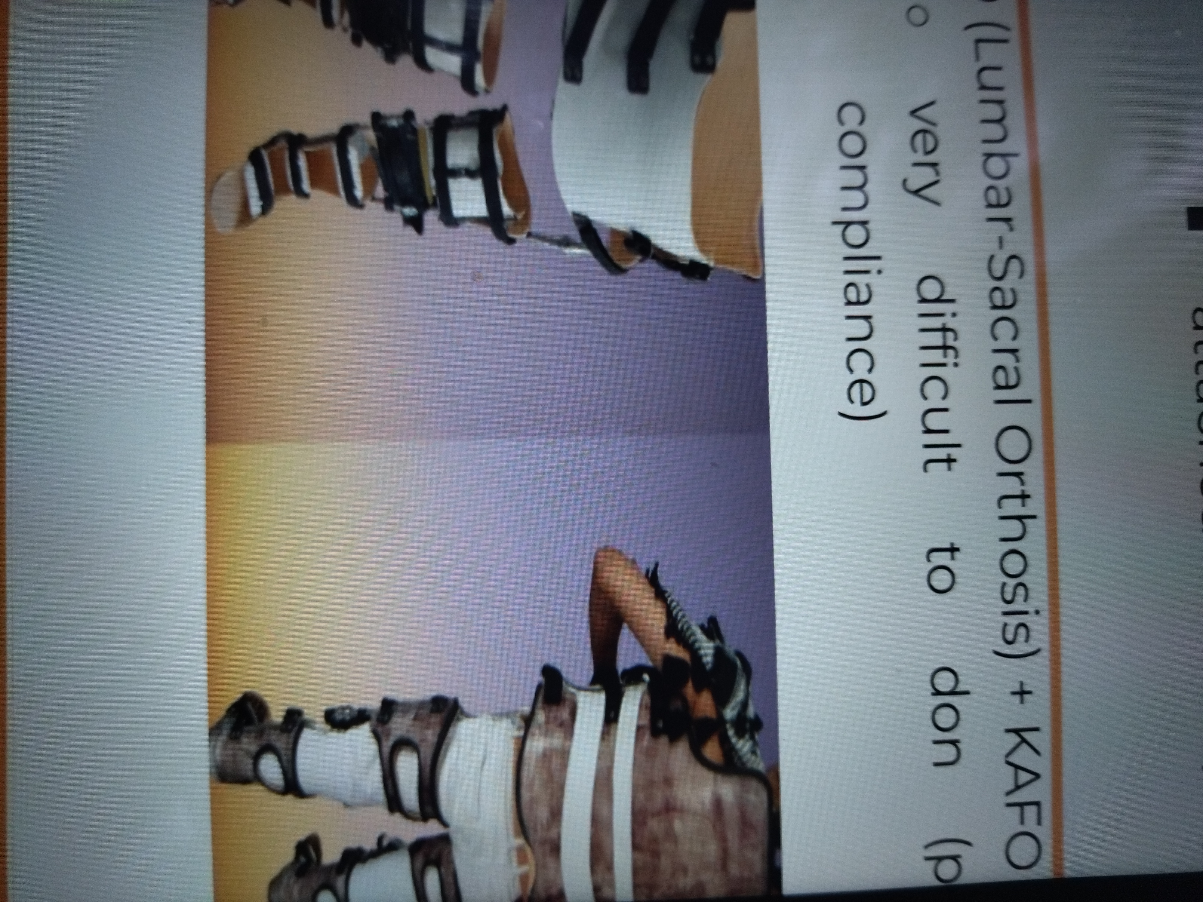 * LSO (Lumbar-Sacral Orthosis) + KAFO
* Very difficult to don (poor pt. compliance)