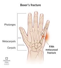 <p>Fractures of 5th metacarpal</p>