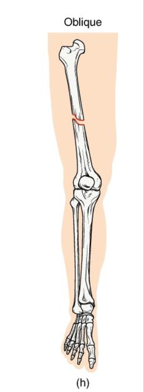 <p><strong>Definition: Diagonal fracture line</strong> across the bone shaft.</p><p><strong>Mechanism</strong>:<strong> angles force applied along the long axis.</strong></p><p><strong>Clinical note:</strong> Sharp ends may lead to displacement; requires stabilization.</p><p><strong>Key concept: often confused with spiral fractures -</strong> but lacks twist pattern</p>
