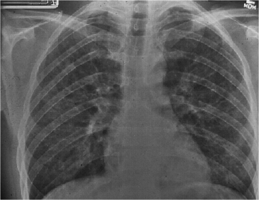 <p>what does this CXR show?</p>