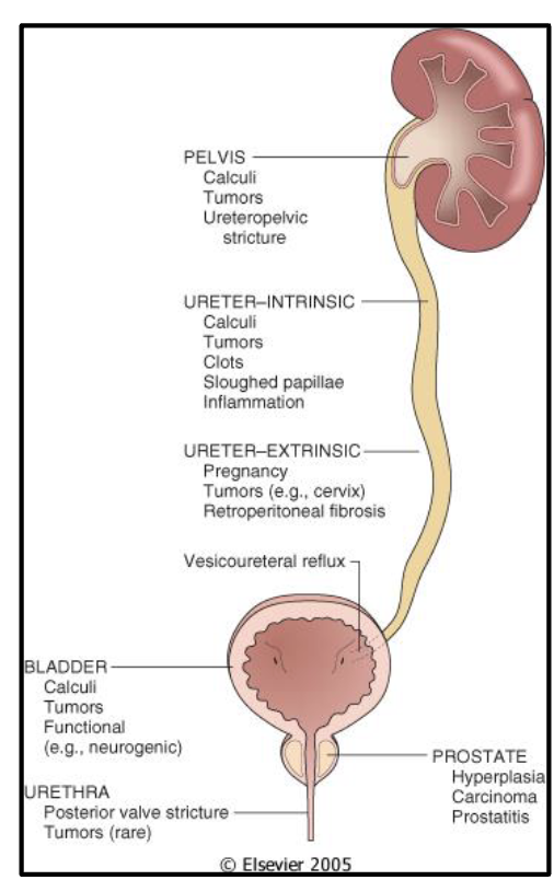 <ul><li><p>any obstruction will predispose to an infection (usually bacterial)</p></li><li><p>urinary tract can be obstructed by many processes</p></li><li><p>in each case infection is a potential complication </p></li></ul><p></p>