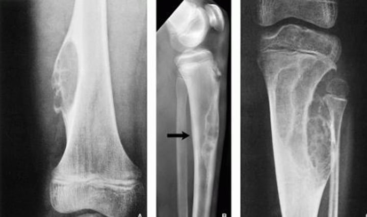 <p>What pathology is seen here?</p>