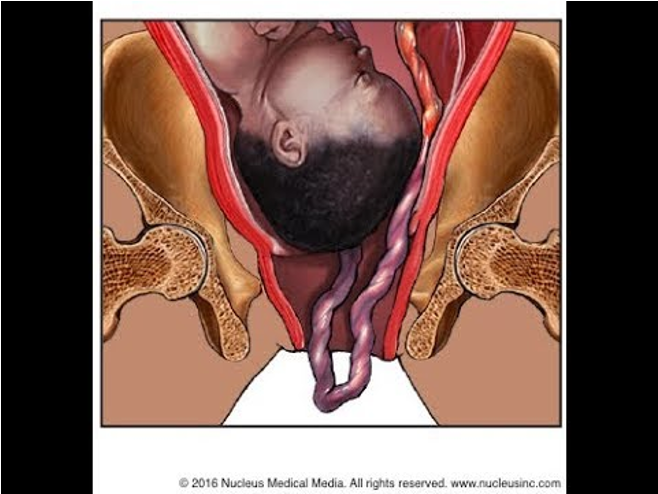 <p>Cord Prolapse</p>