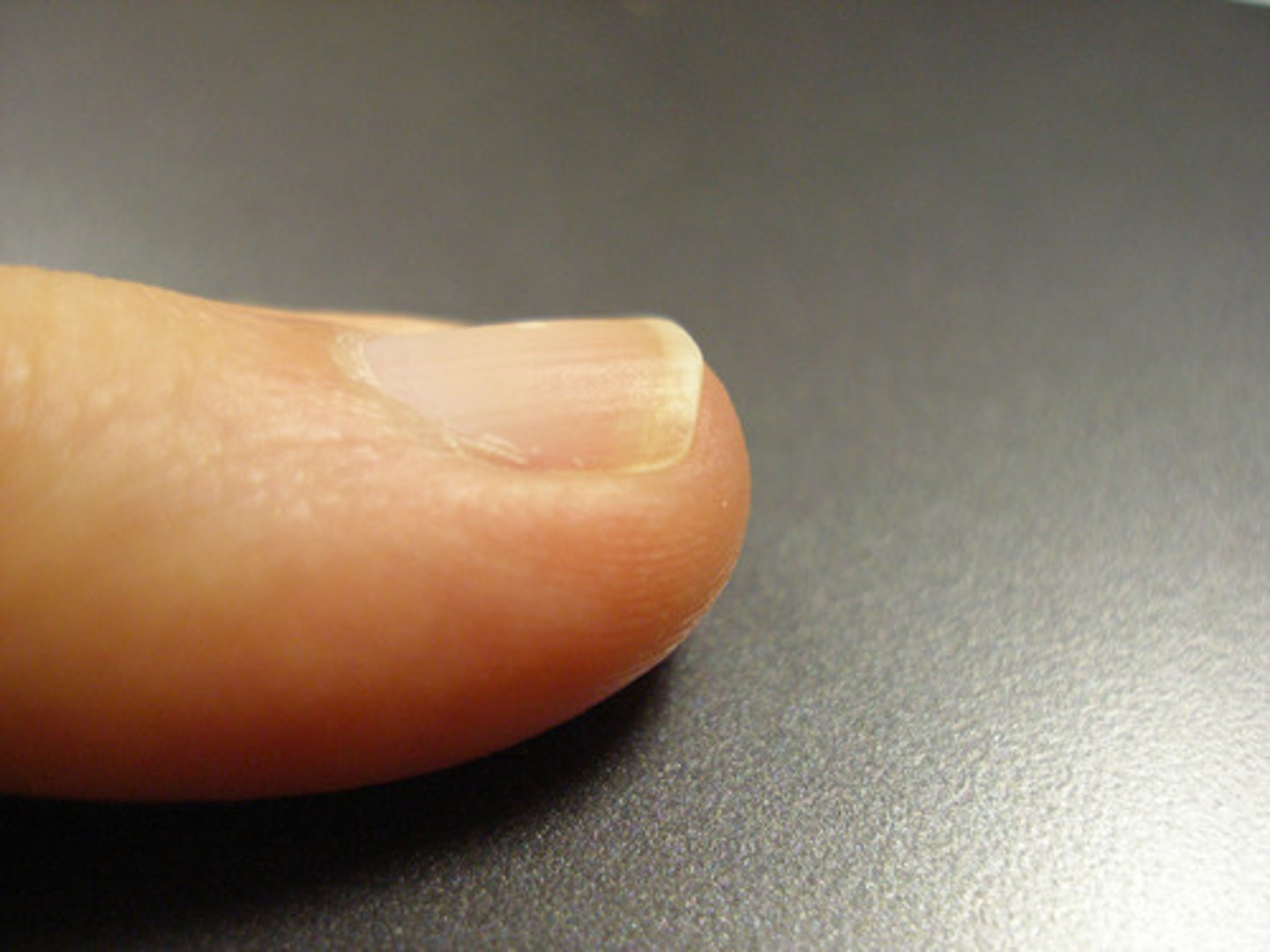 <p>Visible portion of nail. (from distal to proximal) Free Edge, Nail body, Luluna, Eponychium, Nail root (None visible).</p>