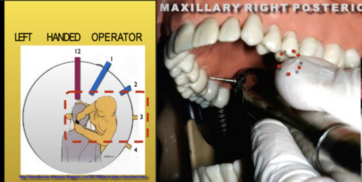 <p>Zone: 3</p><p>Vision: Direct</p><p>Patient's Head: Right</p><p>Fulcrum: Max Left Premolars (O)</p>