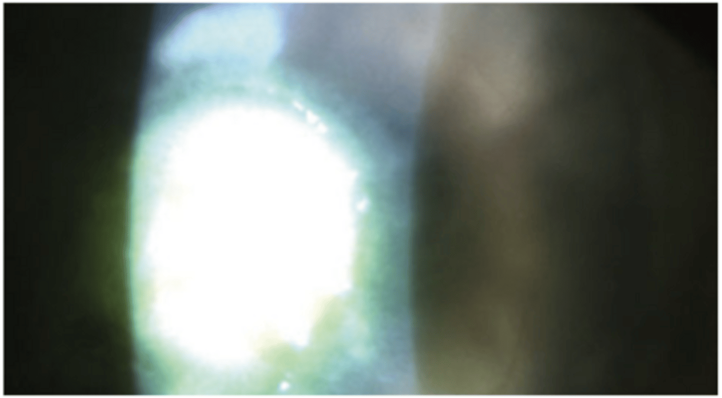 <p>What is the classic presentation of staphylococcus/ streptococcus?</p>