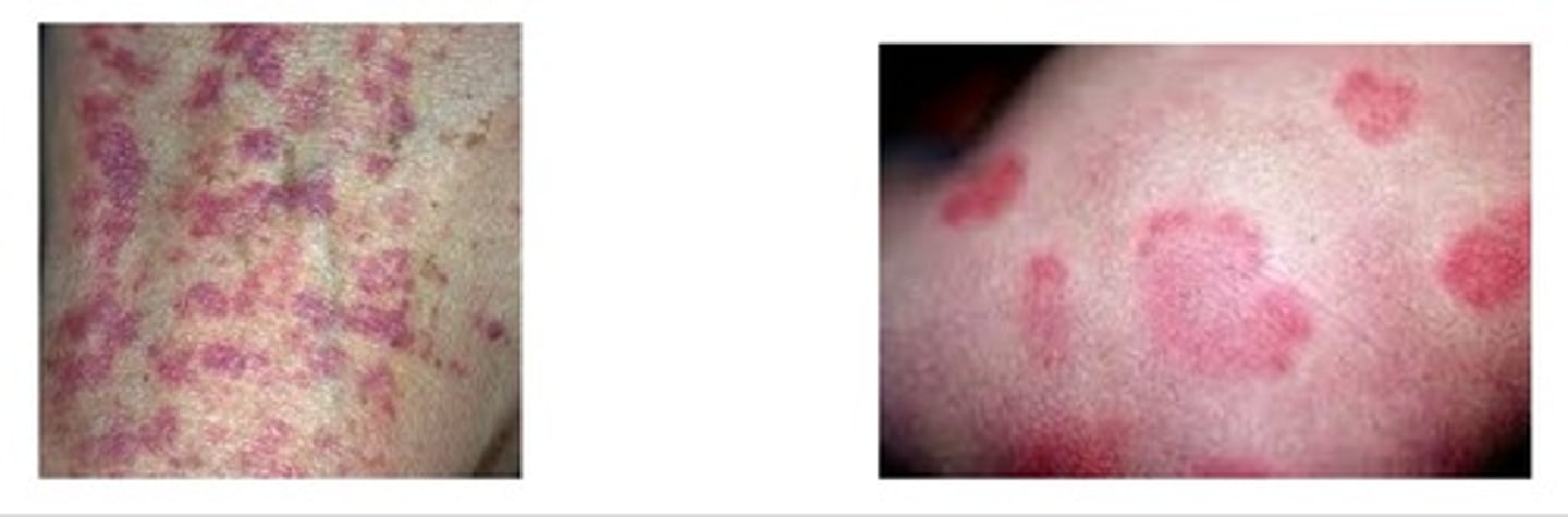 <p>What's are these 3 skin manifestations of CKD?</p>