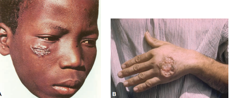 <p>starts with a papule that enlarges into a craterlike ulcer Individual ulcers may coalesce, causing severe tissue destruction and disfigurement</p>