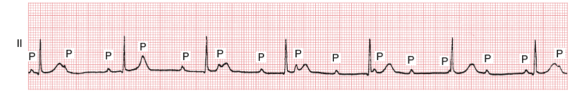 <p>a type of heart block where there is <strong>no relationship</strong> between the atrial and ventricular rates, leading to a slow heart rate, URGENT CAN BE FATAL</p>