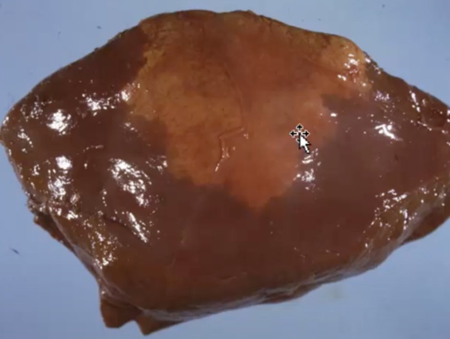 <p>What has caused this gross appearance of this liver?</p>