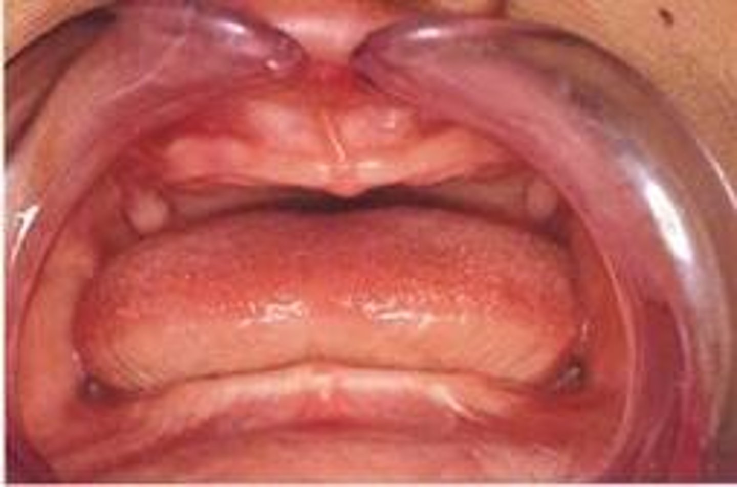 <p>all teeth missing, associated with ectodermal dysplasia</p>