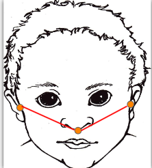<ul><li><p>Tragions - point just anterior to ear</p></li><li><p>Subnasion - point at the center of the tip of the nose</p></li><li><p>length of right tragion to subnasion </p></li><li><p>difference between right and left </p></li><li><p>measures ear asymmetry </p></li></ul><p>Tool - Facial Caliper or Tape Measure</p>