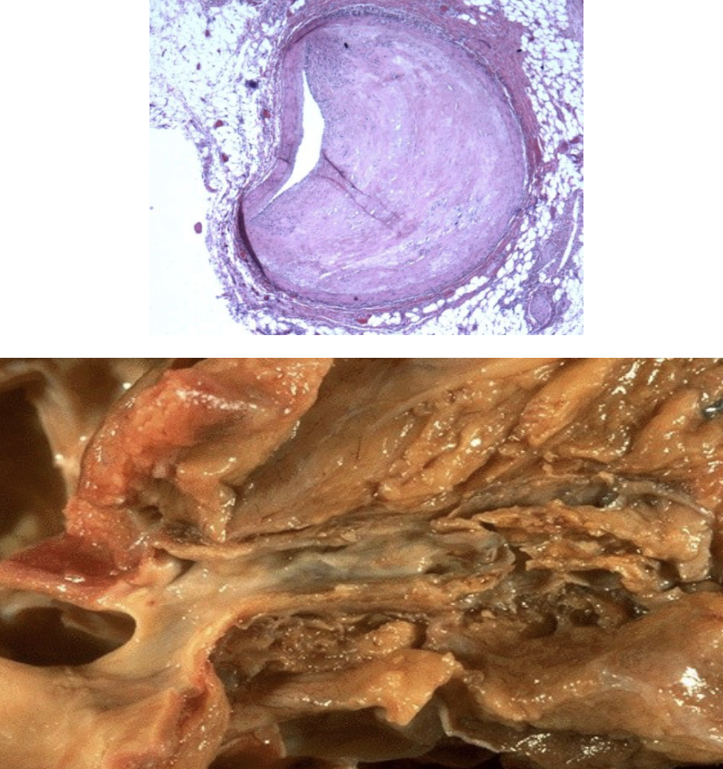 <p>Fibrous Plaque (Atherosclerosis)</p>