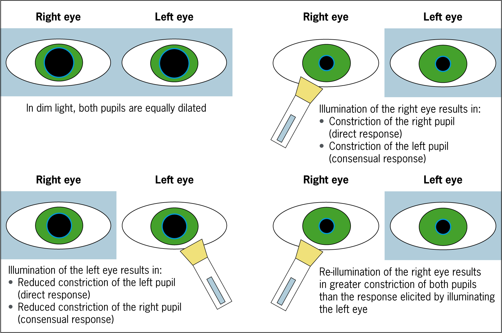 <p>"Afferente Pupillenstörung. Bei afferenter Störung: beleuchtete Pupille wird beim Wechsel größer (Ausreißen der Pupille)"</p><p></p><p>Bei afferenter Störung zeigt die durch die Beleuchtung angeschaltete Pupille eine reduzierte Reaktion und wird beim Wechsel der Beleuchtung größer. </p>