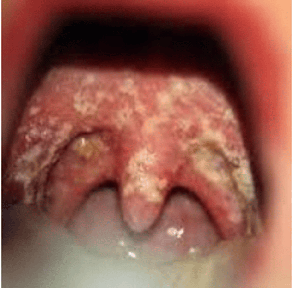 <p>Hyperplastic lymphoid tissue of the soft palate or tonsillar pillars appears as yellowish or</p><p>dark pink nodules</p>
