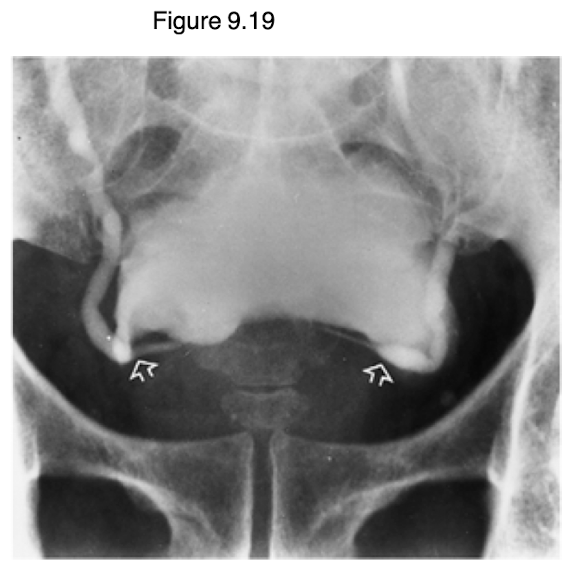 <p>Extrinsic compression</p>