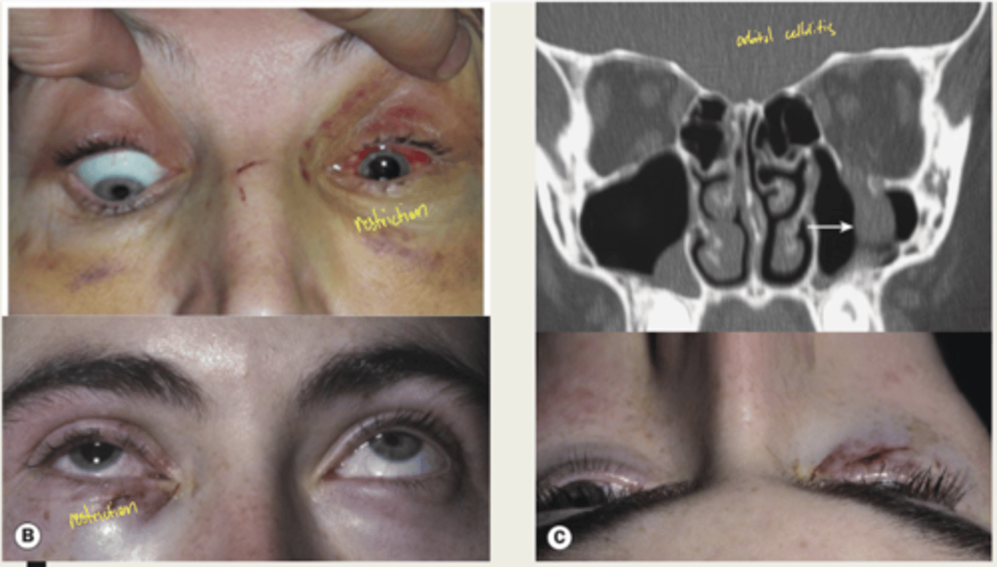 <p>1. lid bruising and edema</p><p>2. subcutaneous crepitus (crackling)</p><p>3. anesthesia of infraorbital nerve</p><p>4. limited IR &amp; IO motility</p><p>5. bone step-off</p><p>6. proptosis</p><p>7. enophthalmos (if severe) - posterior displacement</p>