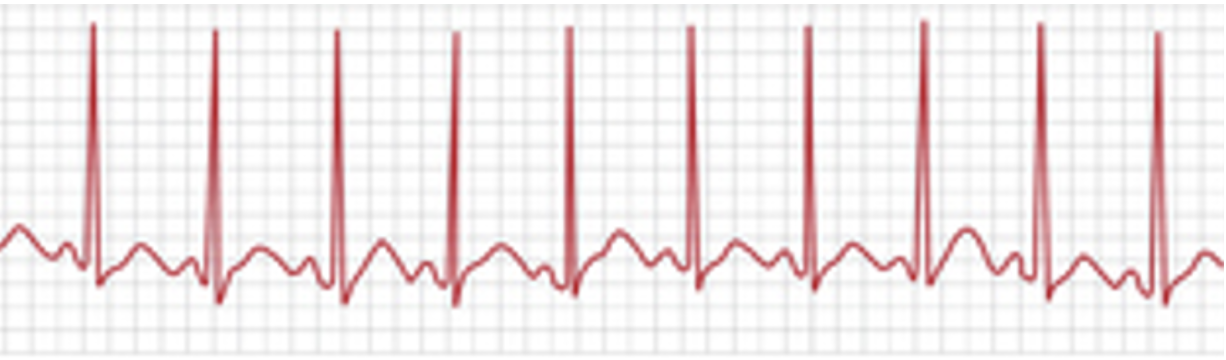 <p>“sinus spikey”</p>