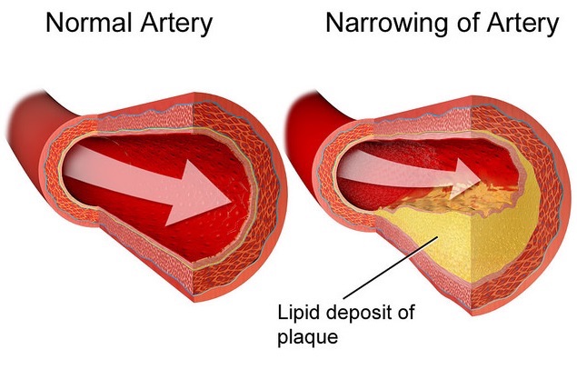 <p>narrowing of arteries due to fatty plaque</p>