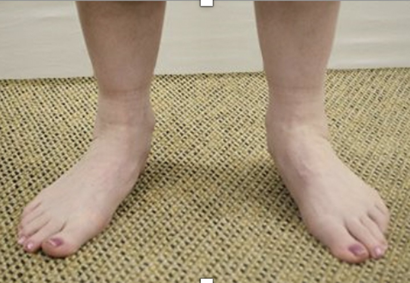 <p>Rationale</p><p>1. Factors that may prolong recovery are a history of an additional lower extremity pathological condition, presence of other medical conditions, or severe obesity. The fibularis (peroneus) brevis is not a medial longitudinal arch support, and the level of dorsiflexion is functional. Therefore, this option should not result in prolonged recovery of the fasciitis. (Magee, pp. 903-904, 915)</p><p>2. The tibialis posterior can act as a support for the medial longitudinal arch of the foot and thereby reduce the strain on the plantar fascia in the pronated position. However, the level of tibialis posterior weakness is small, and the degree of talocrural dorsiflexion is functional. Therefore, these factors would not alter the rate of recovery to a substantial degree. (Magee, pp. 903-904, 915)</p><p>3. This option includes a body mass index (BMI) in the morbid obesity classification. However, the limitation of plantar flexion is minimal, compared to the discharge criteria of 40°. In addition, limited plantar flexion should not strain or elongate the plantar fascia. Therefore, this option only has one factor that would prolong recovery. (Kisner, p. 868)</p><p>4. BODY MASS INDEX 36 KG/M^2 AND 0˚ TO 25˚ HALLUX EXTENSION ROM. The description of the patient is consistent with a diagnosis of plantar fasciitis (Magee, p. 947). Interventions for the diagnosis of plantar fasciitis should focus on the goals of midfoot stability, functional foot and ankle range of motion, Normal (5/5) foot and ankle strength, minimal pain, and return to functional status for activities of daily living and vocational activities. Extra body weight places increased loads on the plantar fascia. Obesity and even a body mass index greater than 25 kg/m2 would be a contributing factor. In addition, the range of motion for hallux extension is more than 50% limited from the normal range of 70°. Therefore, the factors in this option should result in the greatest delay in recovery. (Magee, p. 915)</p><p>Underweight = <18.5</p><p>Normal weight = 18.5-24.9</p><p>Overweight = 25-29.9</p><p>Obesity = BMI of 30 or greater</p>