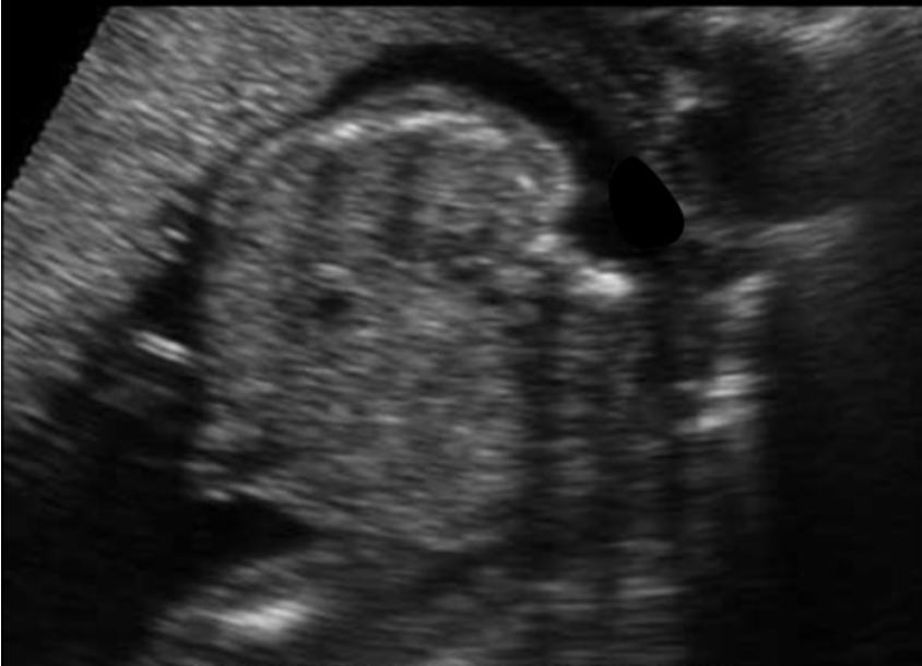 <p>a) there are no kidneys identified on either side of the normal lumbar spine</p><p>b) there are 2 normal kidneys seen but there is cystic hygroma too</p><p>c) there are normal kidneys seen on either side of normal lumbar spine</p><p>d) there are 2 normal kidneys seen but spina bifida too </p>