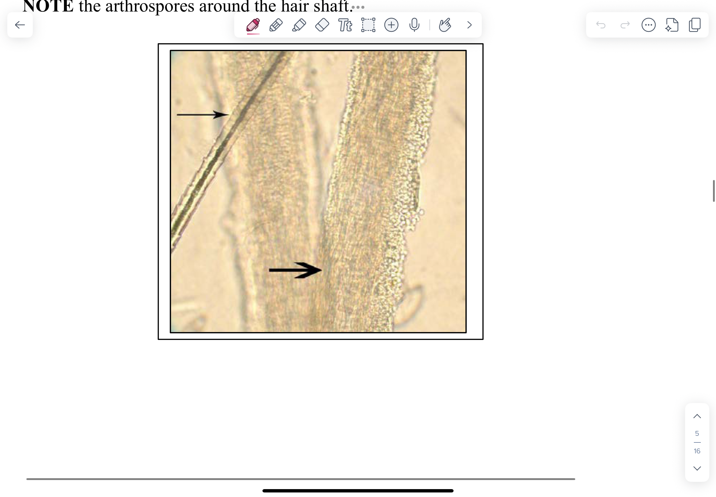 <p>10% KOH can be used to clear skin, hair, mucosal scrapings, sputum and allow fungal elements to be easily visualized.</p><p></p><p>Note the arthrospores around the hair shaft.</p>