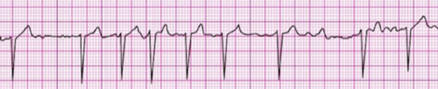<p>Atrial fibrillation</p>