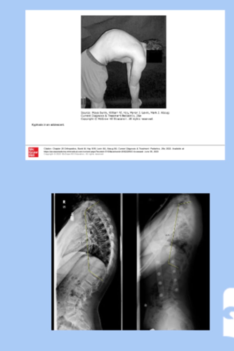 <p>-exaggerated posterior convexity of thoracic region </p><p>-associated with scoliosis</p><p>-sx: deformity visible on back </p><p>-dx: standing AP and lateral XR</p><p>-tx: mild bracing, surgical </p>